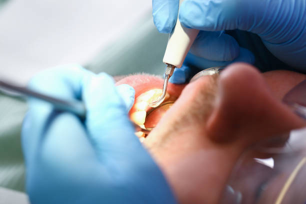 Best Emergency Dental Care for Broken or Chipped Teeth in Suamico, WI